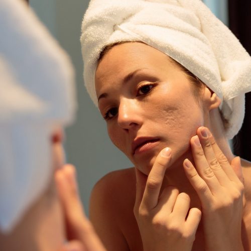 HP-Feature_woman_w_acne_scars-min_c8e870d2-0390-4e71-b41d-fdb18ede145b_1200x1200.jpg HP-Feature_woman_w_acne_scars-min_c8e870d2-0390-4e71-b41d-fdb18ede145b_1200x1200.jpg