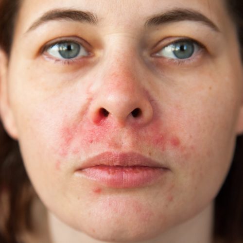 Perioral-Dermatitis.jpg