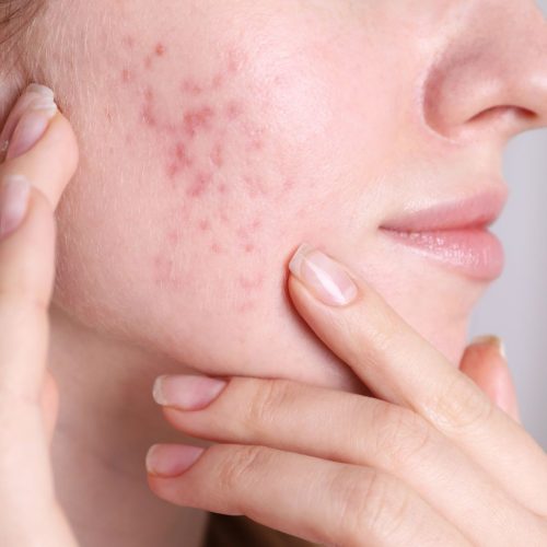 Thumbnail_100_PURE_Acne_Scars_Be_Gone__7_Natural_Solutions_for_Flawless_Skin_1200x1200.jpg Thumbnail_100_PURE_Acne_Scars_Be_Gone__7_Natural_Solutions_for_Flawless_Skin_1200x1200.jpg