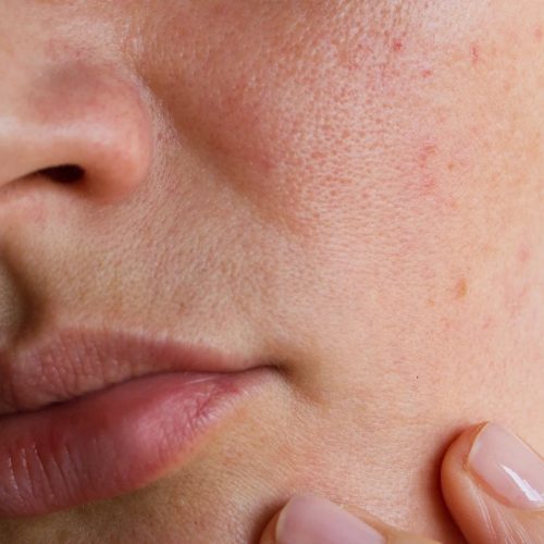 can_you_have_rosacea_and_seborrhea_on_one_side_of_your_face.webp.jpeg