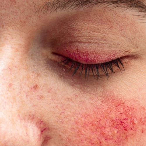 demodex-mites-rosacea-treatment.jpg demodex-mites-rosacea-treatment.jpg
