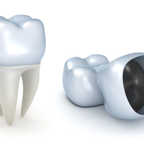 dental-crowns-for-teeth-west-chester.jpg dental-crowns-for-teeth-west-chester.jpg