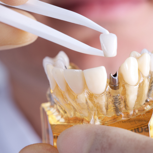 dental-implants.png dental-implants.png