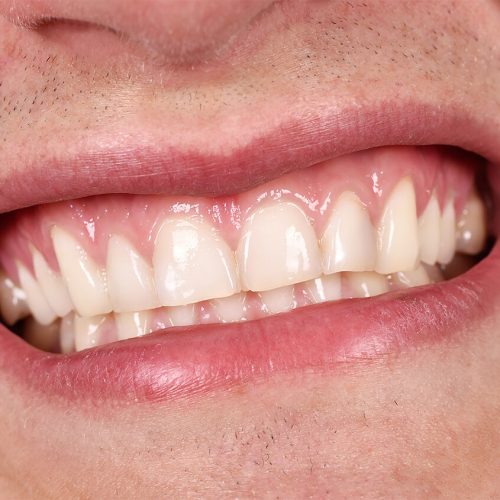 dentist-for-gum-disease-west-chester-pa2.jpg