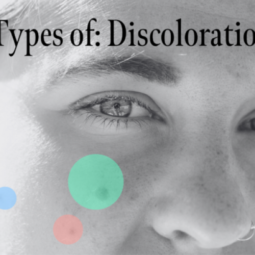 discolorationblogheader2560-x-1652-px-620x400.png