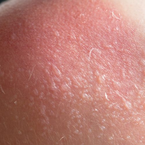 how_to_treat_a_sunburn.jpg how_to_treat_a_sunburn.jpg