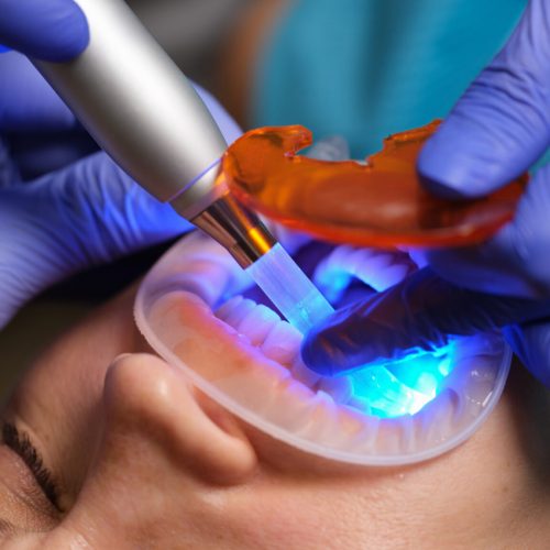 nanoparticles-adheisve-resin-dental.jpg
