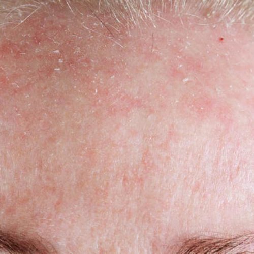 rosacea_and_seborrhea_on_the_forehead.webp.jpeg rosacea_and_seborrhea_on_the_forehead.webp.jpeg