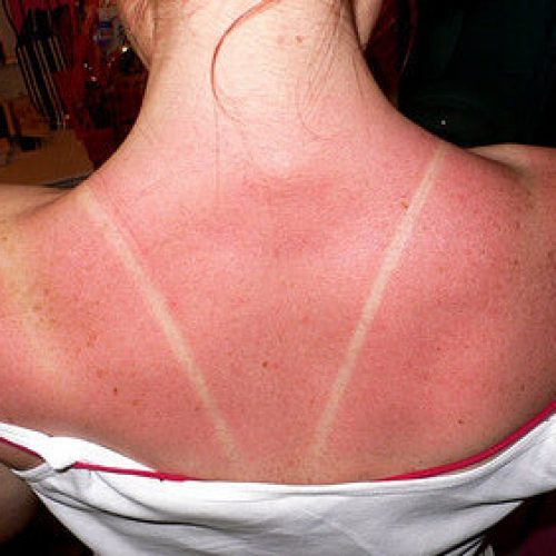 sunburn2.jpg