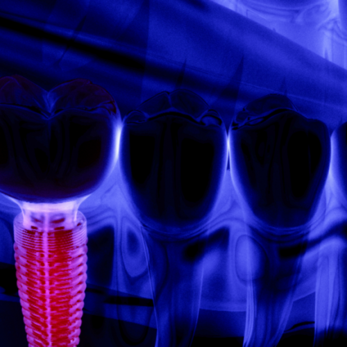 titanium-implants-1024×577.png titanium-implants-1024x577.png